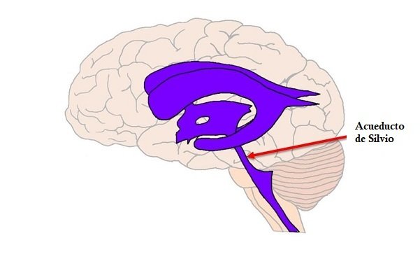 hidrocefalia